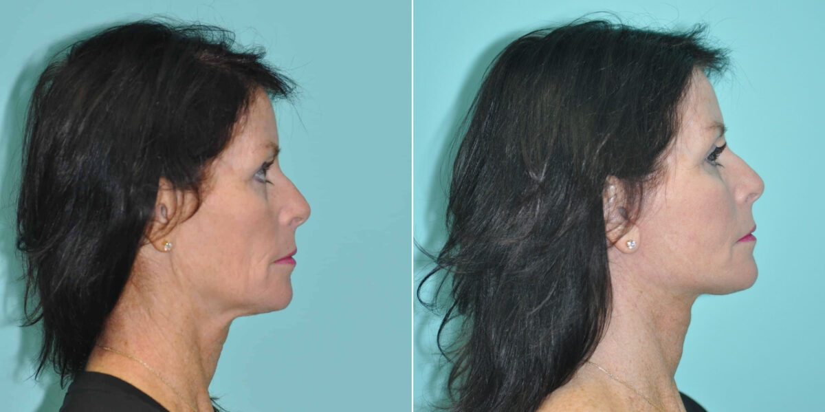 Patient 14683, Fat Transfer Before and After Photos Before and after Fat Transfer by Dr. Shervin Naderi, Patient 14683
