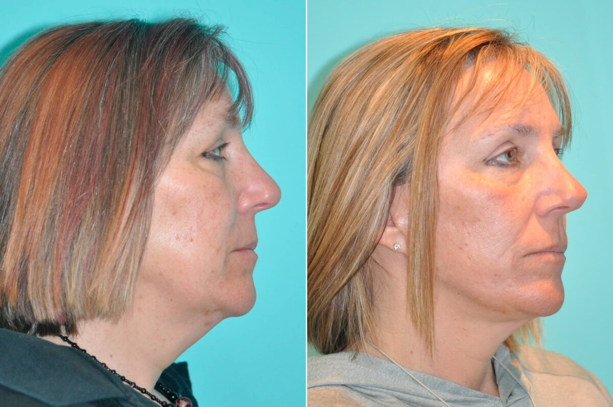 Patient 14712, Neck Lift Before and After Photos Before and after Neck Lift by Dr. Shervin Naderi, Patient 14712