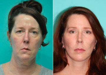 Before and after Facelift by Dr. Shervin Naderi, Patient 14855