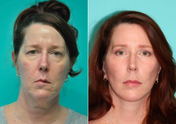Before and after Facelift by Dr. Shervin Naderi, Patient 14855