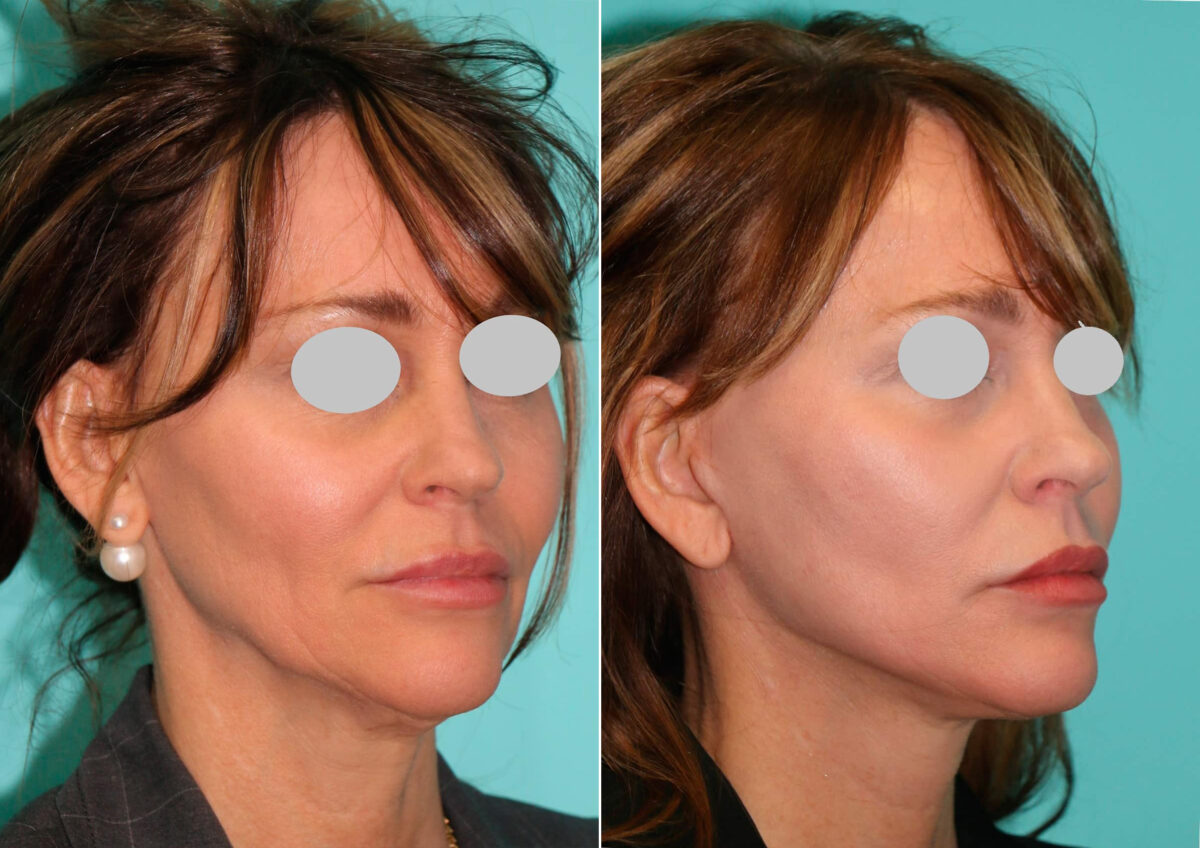 Patient 15036, Facelift Before and After Photos Before and after Facelift by Dr. Shervin Naderi, Patient 15036