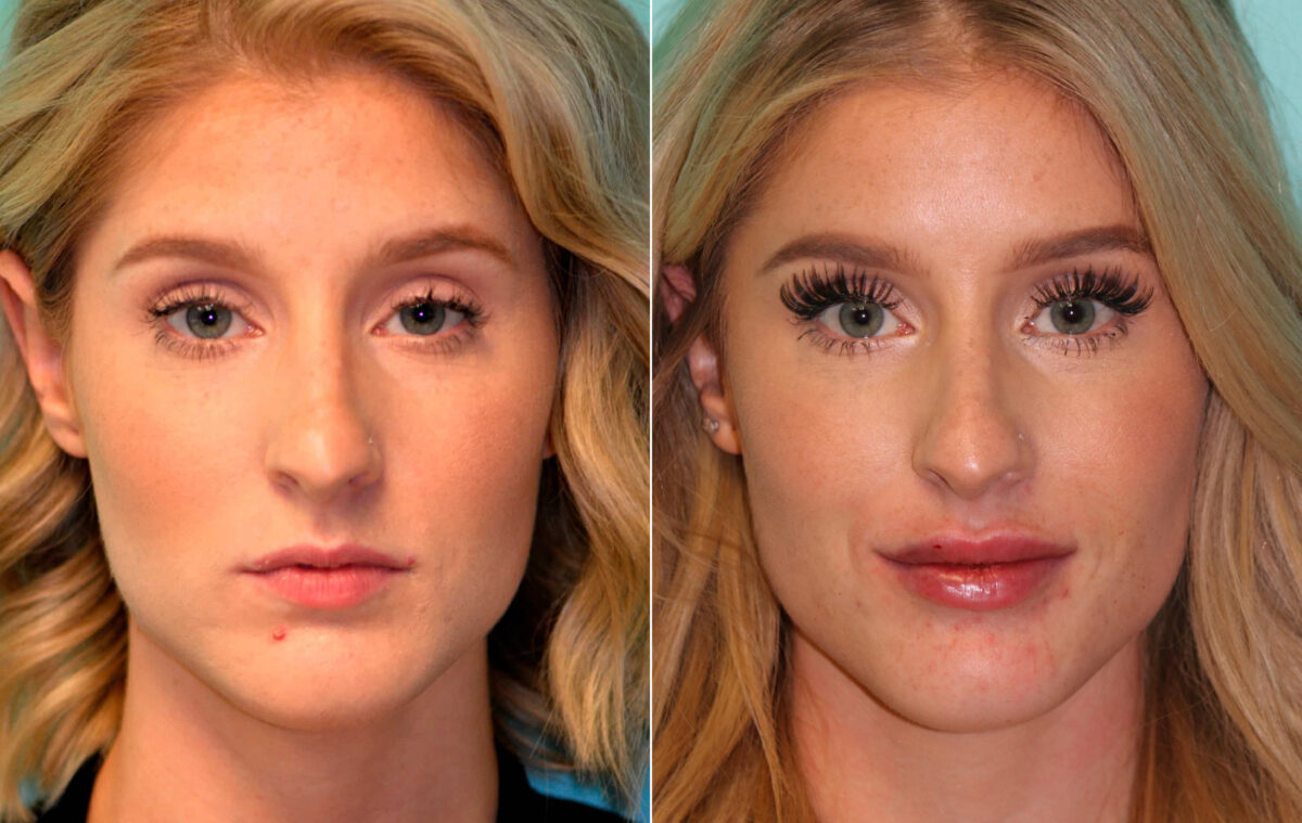 Patient 16116, Lip Augmentation Before and After Photos Before and after Lip Augmentation by Dr. Shervin Naderi, Patient 16116