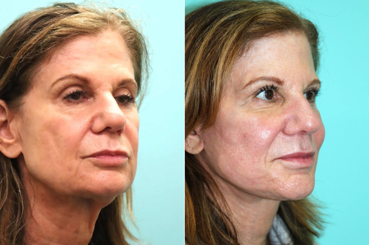 Patient 18641, Facelift Before and After Photos Before and after Facelift by Dr. Shervin Naderi, Patient 18641