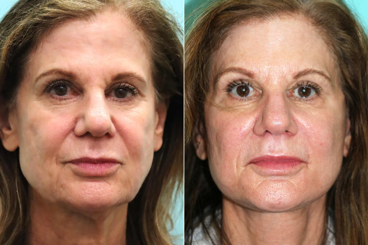 Patient 18641, Facelift Before and After Photos Before and after Facelift by Dr. Shervin Naderi, Patient 18641