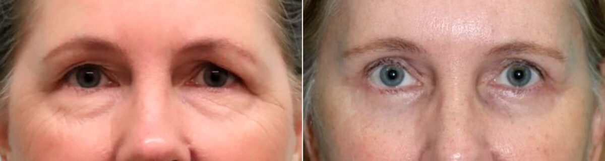 Patient 19149, Blepharoplasty Before and After Photos Before and after Blepharoplasty by Dr. Shervin Naderi, Patient 19149