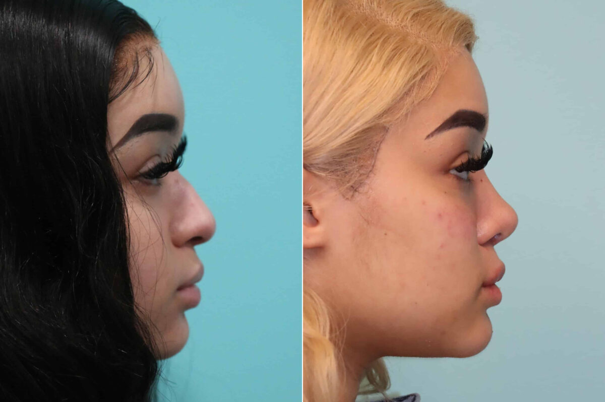 Patient 19620, Cheeks / Midface Injections Before and After Photos Before and after Cheeks / Midface Injections by Dr. Shervin Naderi, Patient 19620