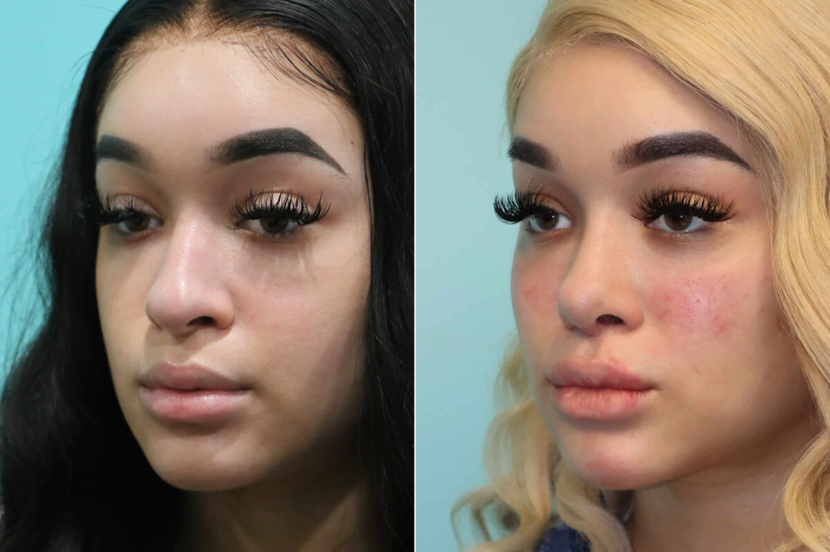 Patient 19620, Cheeks / Midface Injections Before and After Photos Before and after Cheeks / Midface Injections by Dr. Shervin Naderi, Patient 19620