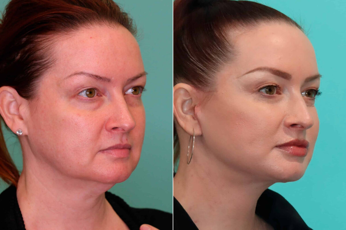 Patient 19943, Facelift Before and After Photos Before and after Facelift by Dr. Shervin Naderi, Patient 19943