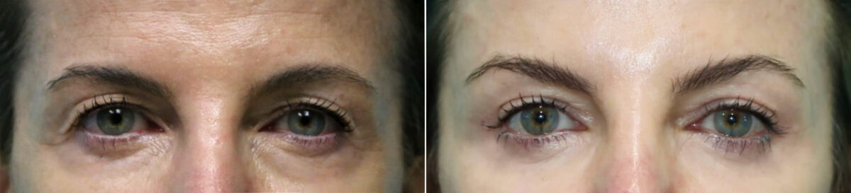 Patient 21268, Blepharoplasty Before and After Photos Before and after Blepharoplasty by Dr. Shervin Naderi, Patient 21268