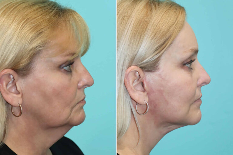 Before and after facelift and neck lift, side profile: loose neck skin and jowls