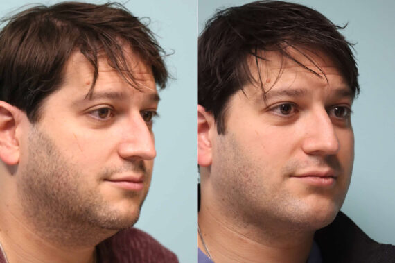Before and after Chin & Facial Implant by Dr. Shervin Naderi, Patient 21382