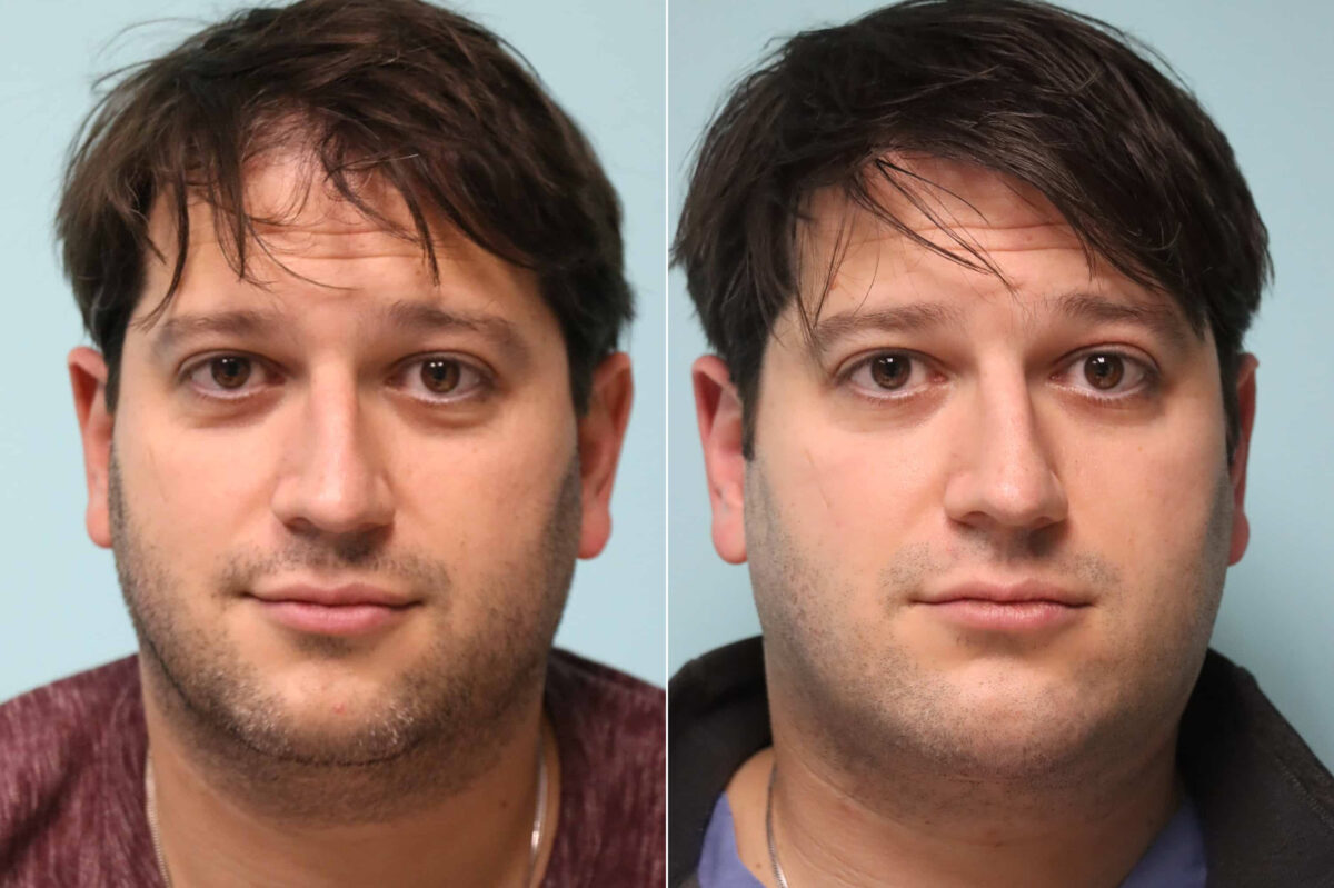 Patient 21382, Chin & Facial Implant Before and After Photos Before and after Chin & Facial Implant by Dr. Shervin Naderi, Patient 21382