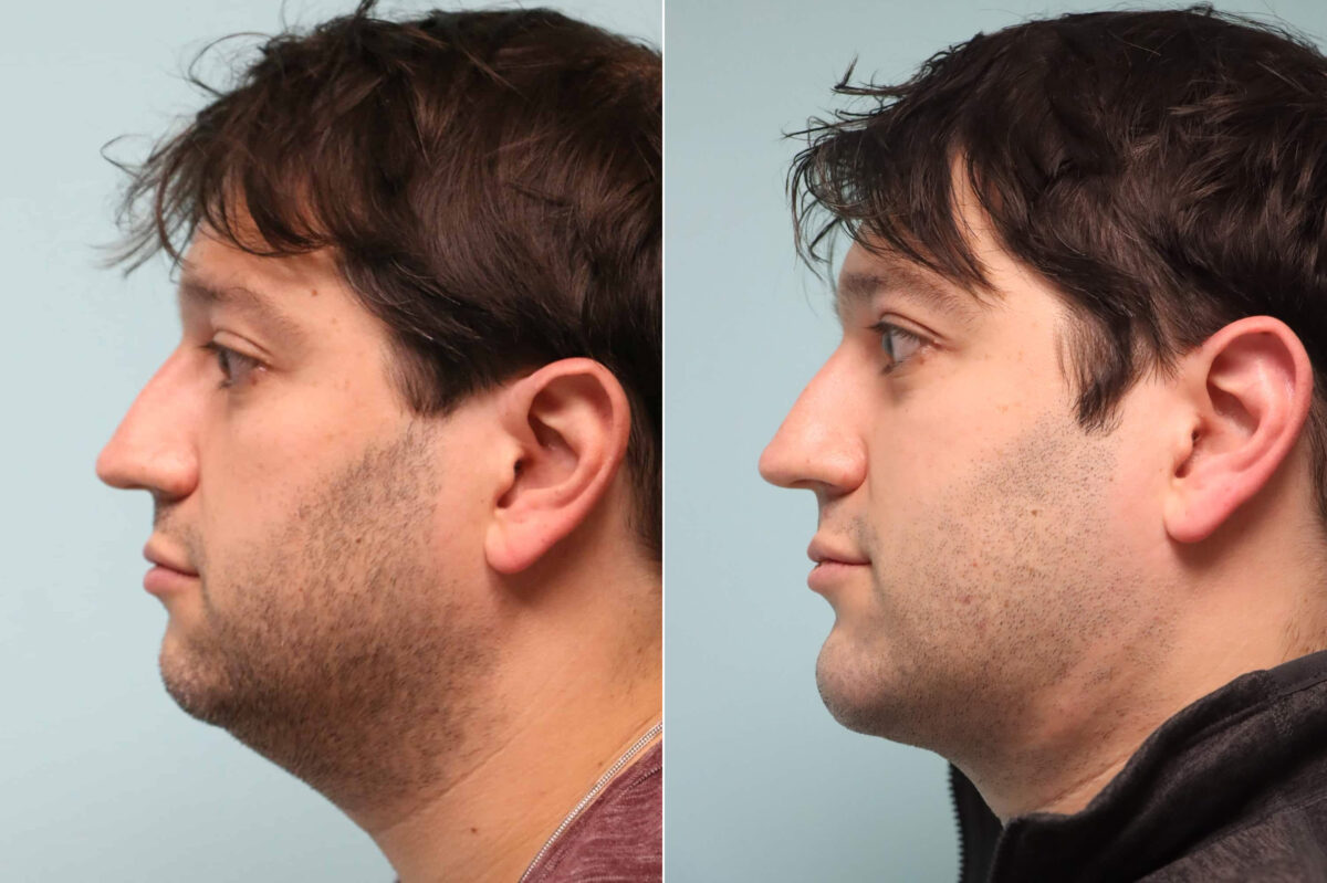 Patient 21382, Chin & Facial Implant Before and After Photos Before and after Chin & Facial Implant by Dr. Shervin Naderi, Patient 21382