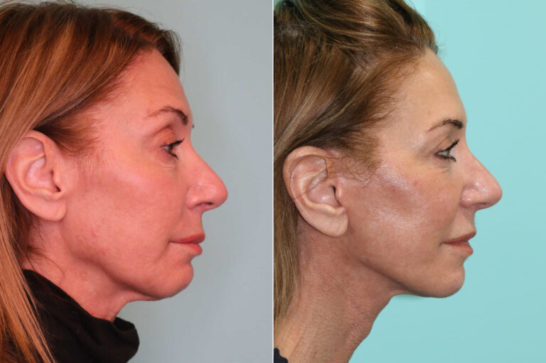 Before and after facelift and neck lift, side profile: a firmer neck and lower face