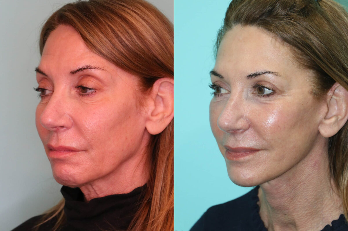 Patient 21726, Facelift Before and After Photos Before and after Facelift by Dr. Shervin Naderi, Patient 21726