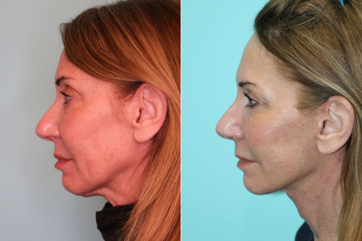 Patient 21726, Facelift Before and After Photos Before and after Facelift by Dr. Shervin Naderi, Patient 21726