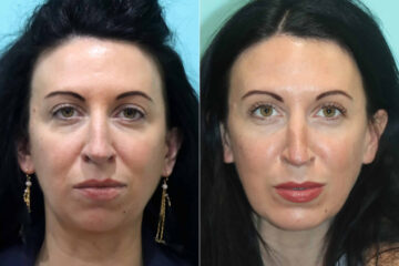 Chin & Facial Implant before and after at The Naderi Center, Reston, VA and Chevy Chase, MD, Patient 21777