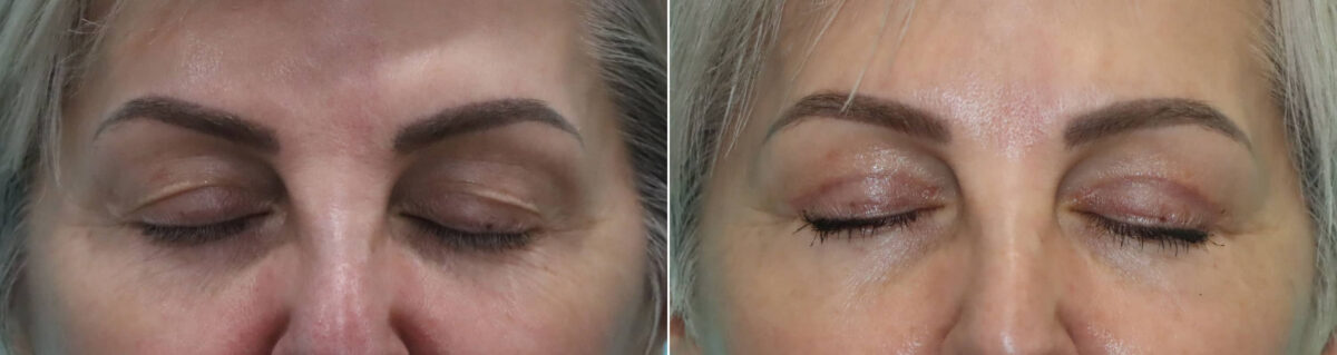 Patient 21998, Blepharoplasty Before and After Photos Before and after Blepharoplasty by Dr. Shervin Naderi, Patient 21998