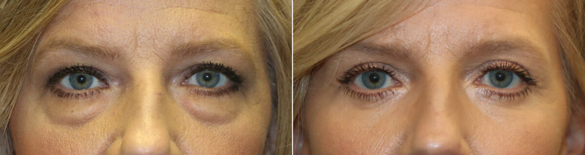 Patient 22162, Blepharoplasty Before and After Photos Before and after Blepharoplasty by Dr. Shervin Naderi, Patient 22162