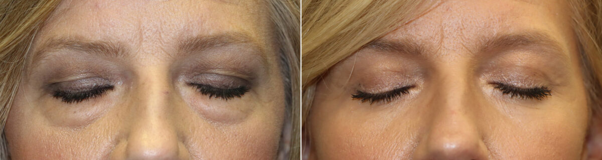 Patient 22162, Blepharoplasty Before and After Photos Before and after Blepharoplasty by Dr. Shervin Naderi, Patient 22162