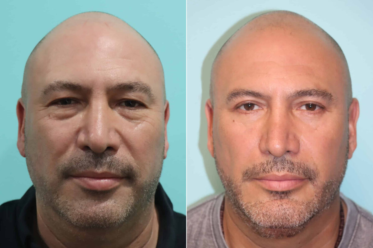 Patient 22654, Blepharoplasty Before and After Photos Before and after Blepharoplasty by Dr. Shervin Naderi, Patient 22654