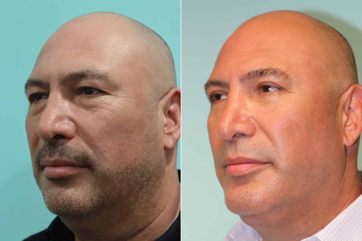 Patient 22654, Blepharoplasty Before and After Photos Before and after Blepharoplasty by Dr. Shervin Naderi, Patient 22654