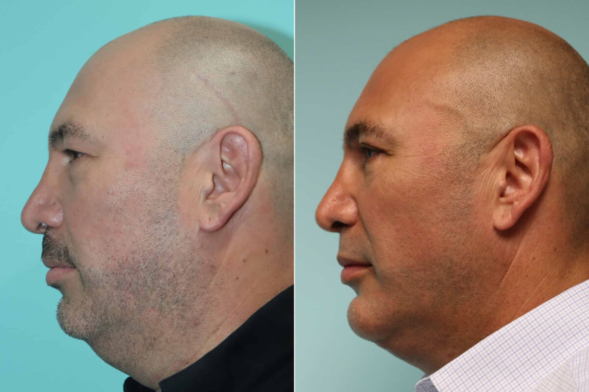 Patient 22654, Blepharoplasty Before and After Photos Before and after Blepharoplasty by Dr. Shervin Naderi, Patient 22654