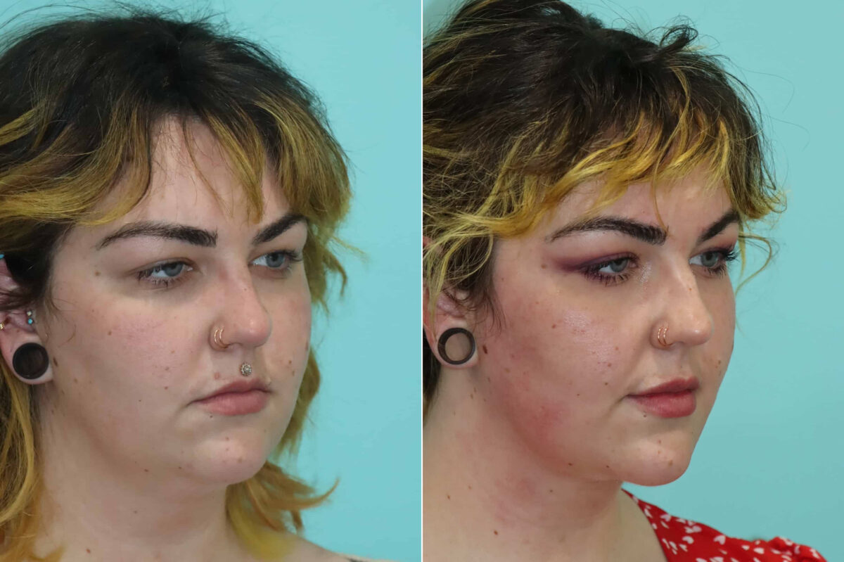 Patient 22859, Submentoplasty Before and After Photos Before and after Submentoplasty by Dr. Shervin Naderi, Patient 22859