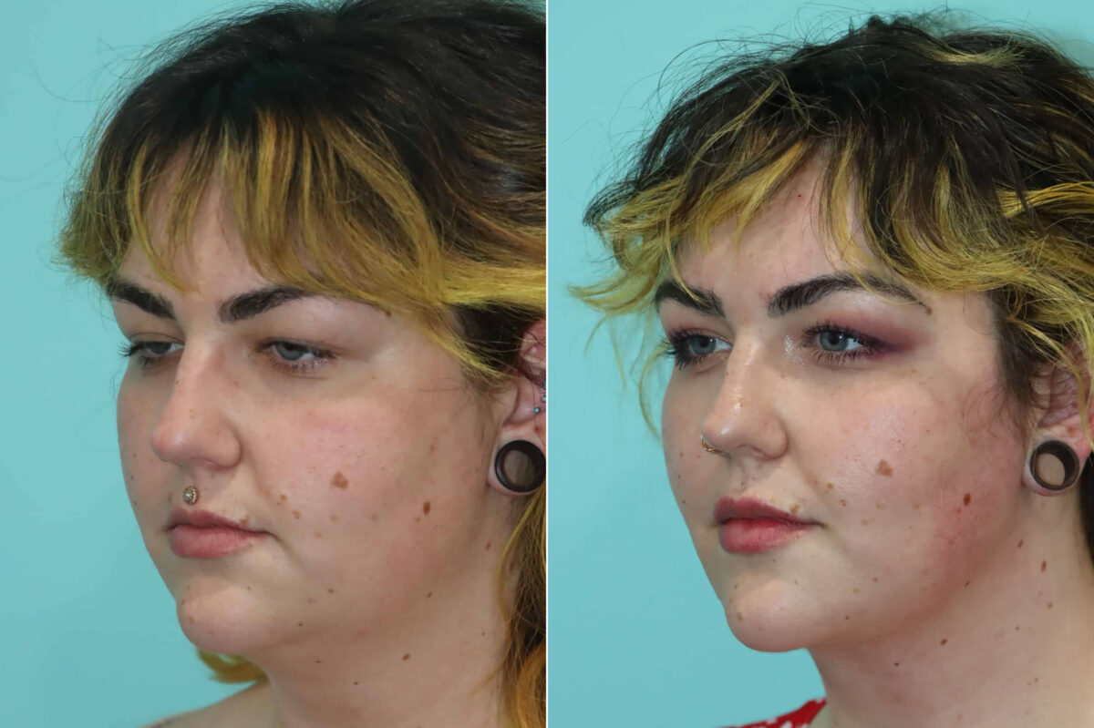 Patient 22859, Submentoplasty Before and After Photos Before and after Submentoplasty by Dr. Shervin Naderi, Patient 22859