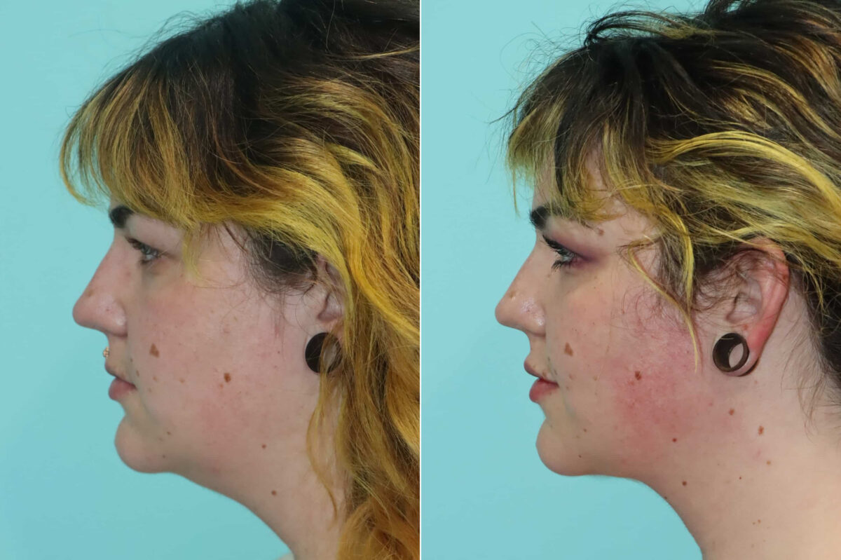 Patient 22859, Submentoplasty Before and After Photos Before and after Submentoplasty by Dr. Shervin Naderi, Patient 22859