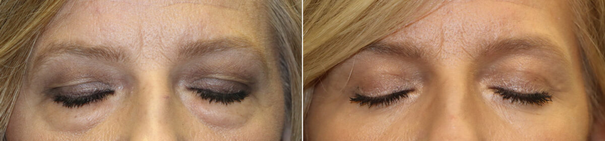 Patient 23428, Blepharoplasty Before and After Photos Before and after Blepharoplasty by Dr. Shervin Naderi, Patient 23428