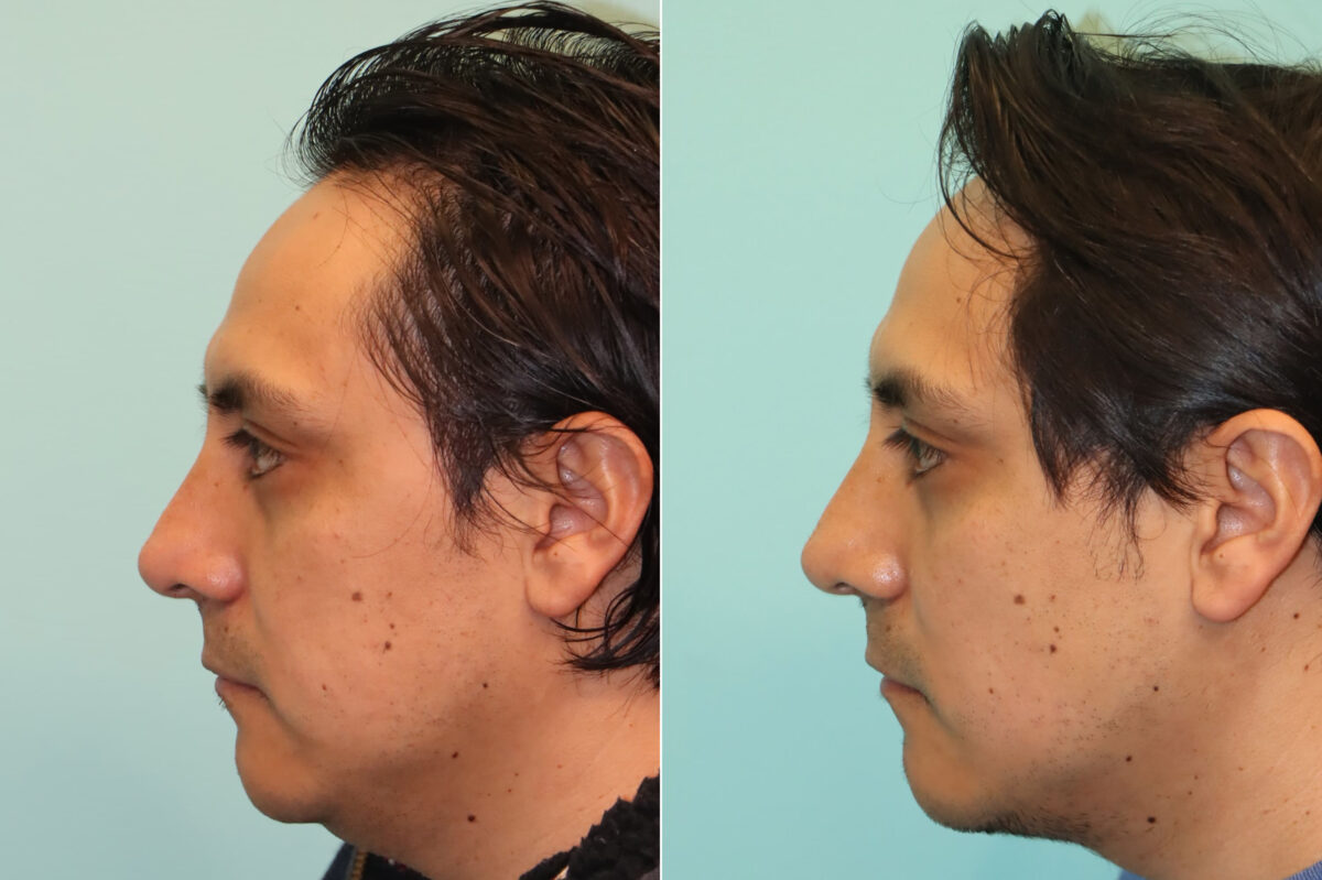 Patient 24121, Submentoplasty Before and After Photos Before and after Submentoplasty by Dr. Shervin Naderi, Patient 24121