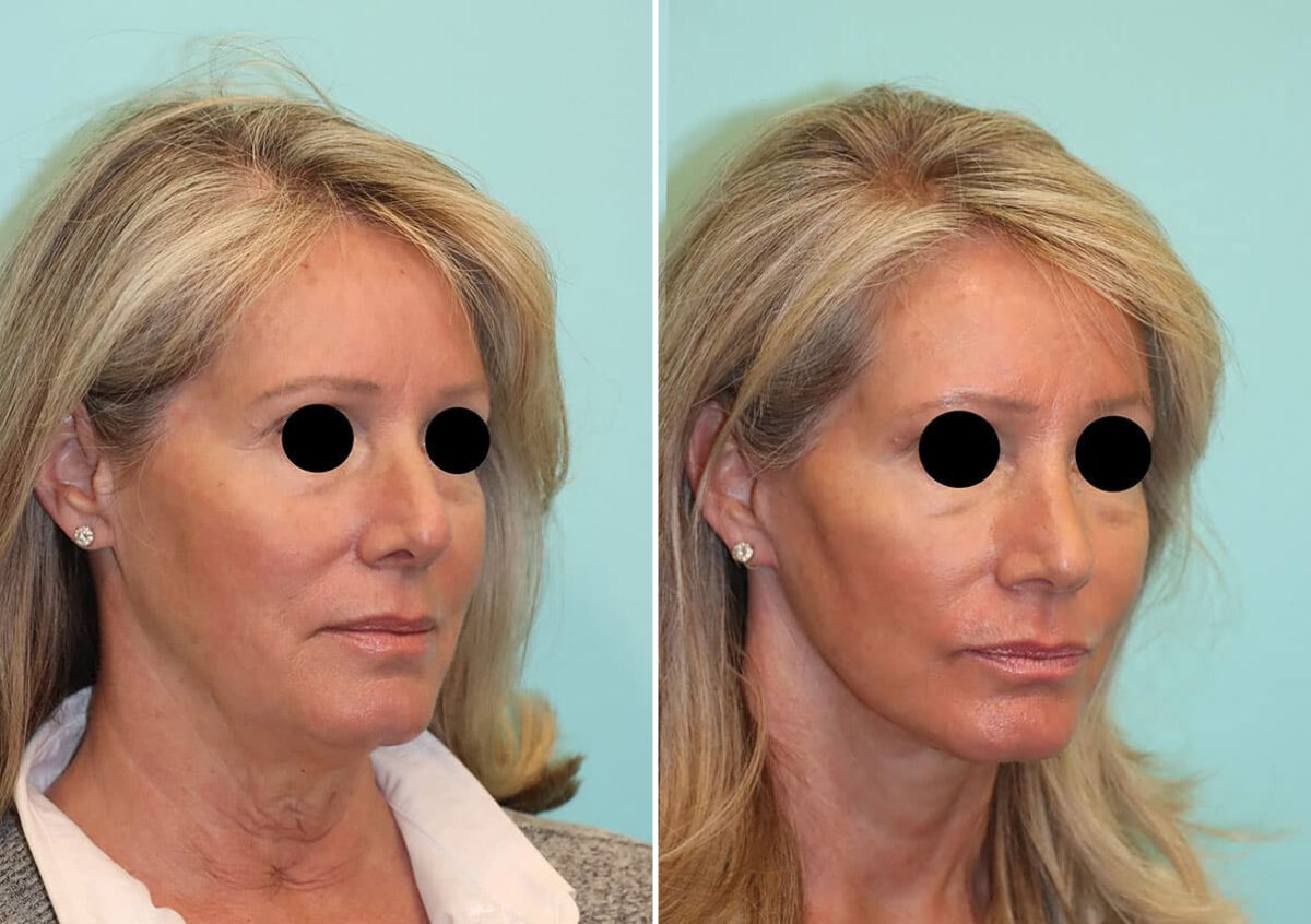 Patient 24251, Facelift Before and After Photos Before and after Facelift by Dr. Shervin Naderi, Patient 24251