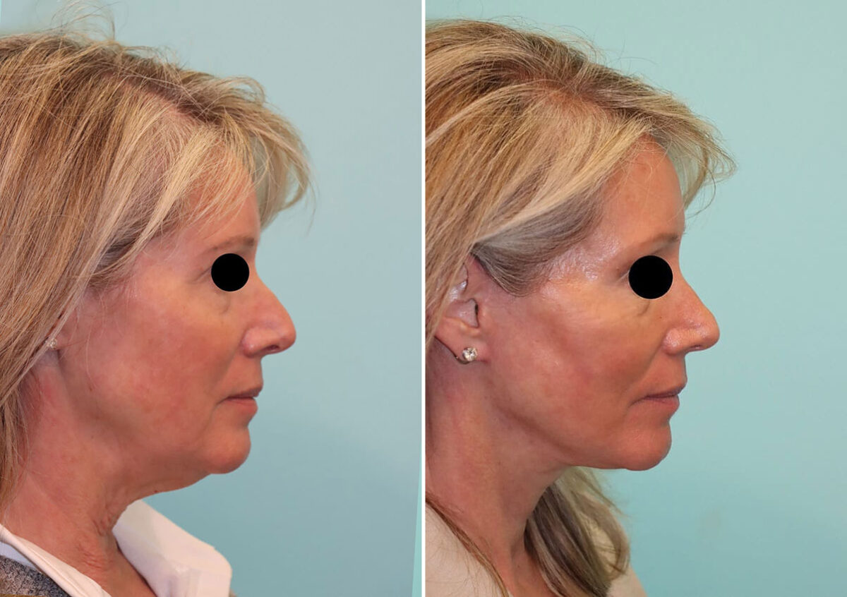Patient 24251, Facelift Before and After Photos Before and after Facelift by Dr. Shervin Naderi, Patient 24251