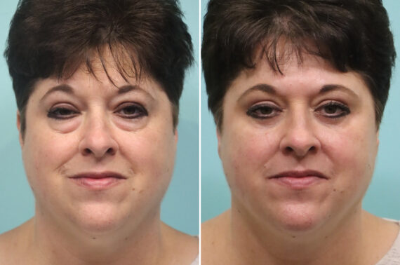 Before and after Blepharoplasty by Dr. Shervin Naderi, Patient 25599