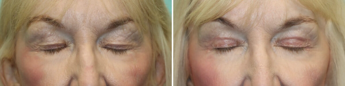 Patient 25661, Blepharoplasty Before and After Photos Before and after Blepharoplasty by Dr. Shervin Naderi, Patient 25661