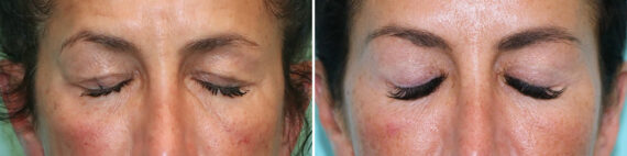 Before and after Blepharoplasty by Dr. Shervin Naderi, Patient 28073