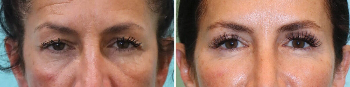 Before and after Blepharoplasty by Dr. Shervin Naderi, Patient 28073
