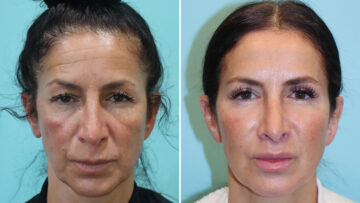 Before and after Botox Injections by Dr. Shervin Naderi, Patient 28080