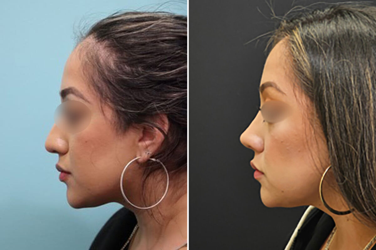 Before and after Rhinoplasty by Dr. Shervin Naderi, Patient 28146