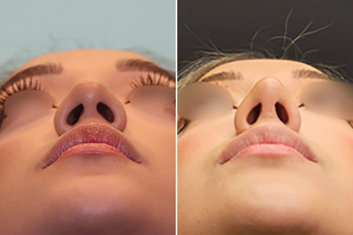 Before and after Rhinoplasty by Dr. Shervin Naderi, Patient 28146