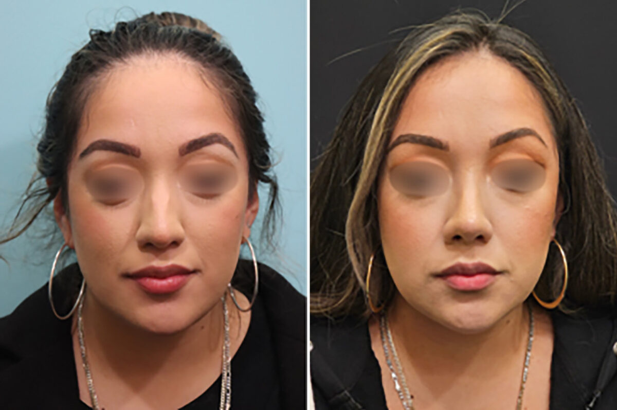 Before and after Rhinoplasty by Dr. Shervin Naderi, Patient 28146