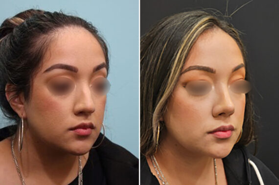 Before and after Rhinoplasty by Dr. Shervin Naderi, Patient 28146