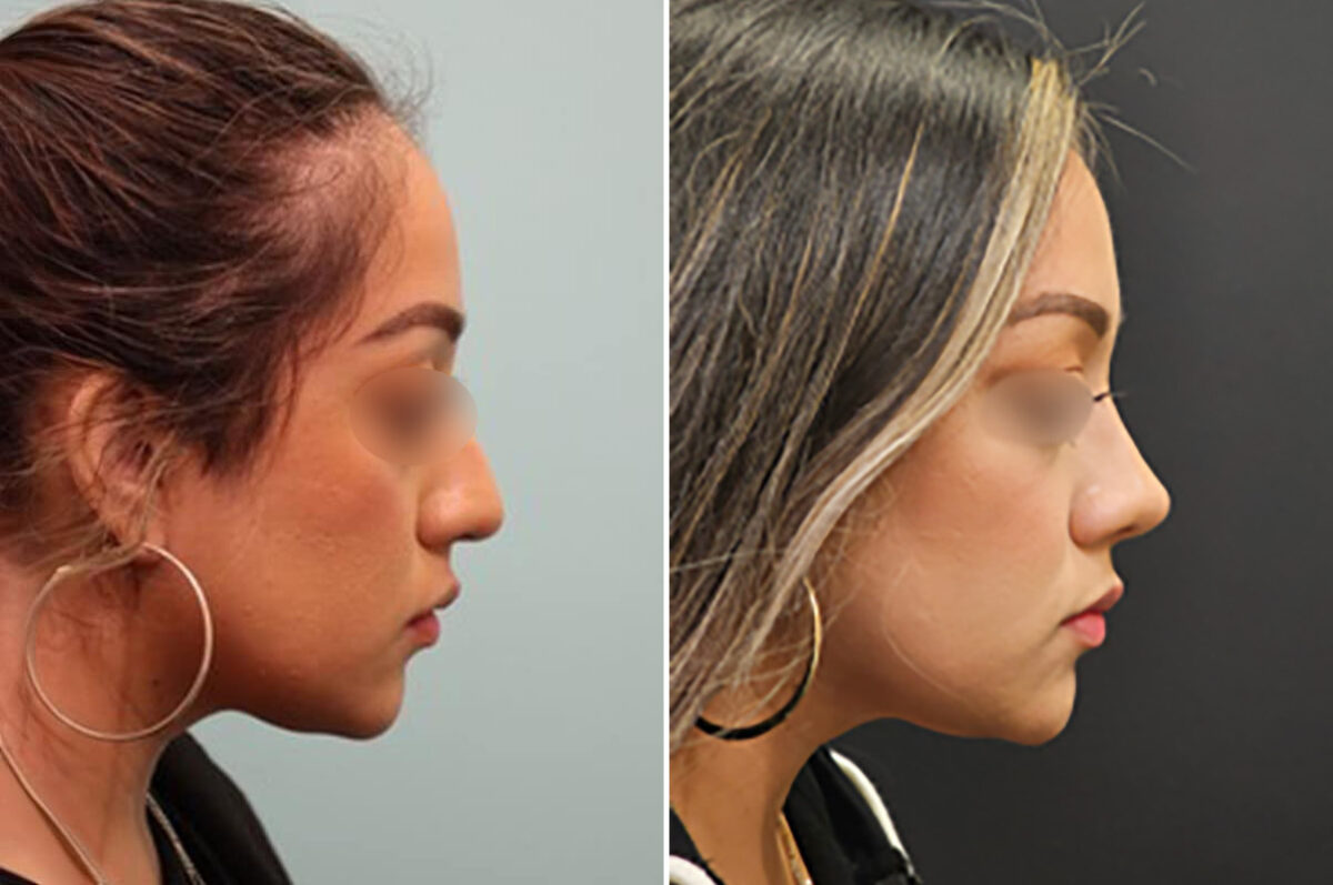 Before and after Rhinoplasty by Dr. Shervin Naderi, Patient 28146