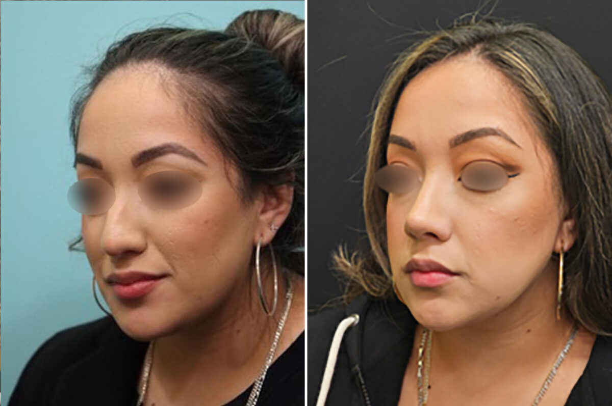 Before and after Rhinoplasty by Dr. Shervin Naderi, Patient 28146