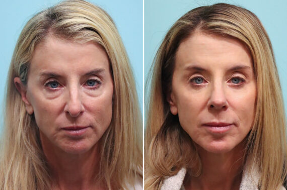 Before and after Rhinoplasty by Dr. Shervin Naderi, Patient 29997