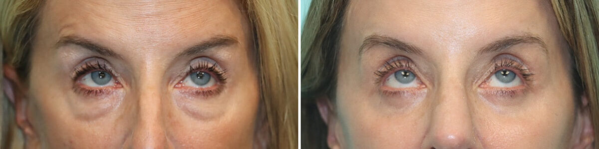 Before and after Blepharoplasty by Dr. Shervin Naderi, Patient 30016