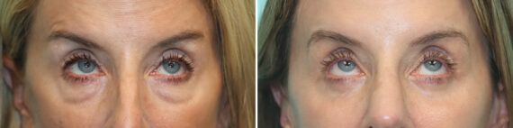 Before and after Blepharoplasty by Dr. Shervin Naderi, Patient 30016