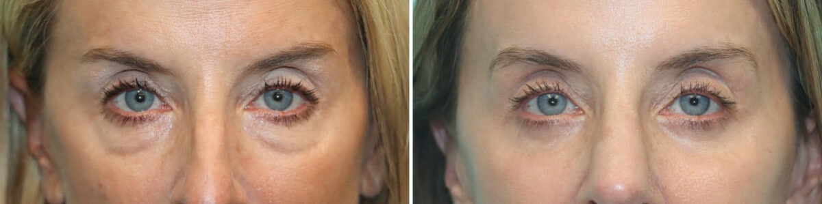 Before and after Blepharoplasty by Dr. Shervin Naderi, Patient 30016