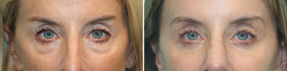 Before and after Blepharoplasty by Dr. Shervin Naderi, Patient 30016